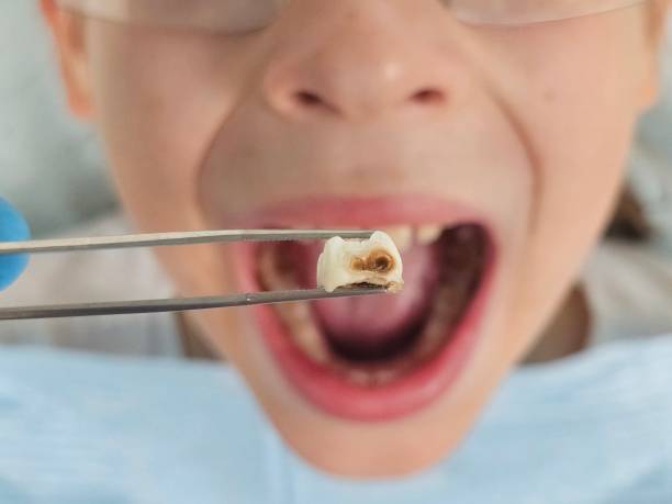 Best Emergency Tooth Extraction in Cardington, OH